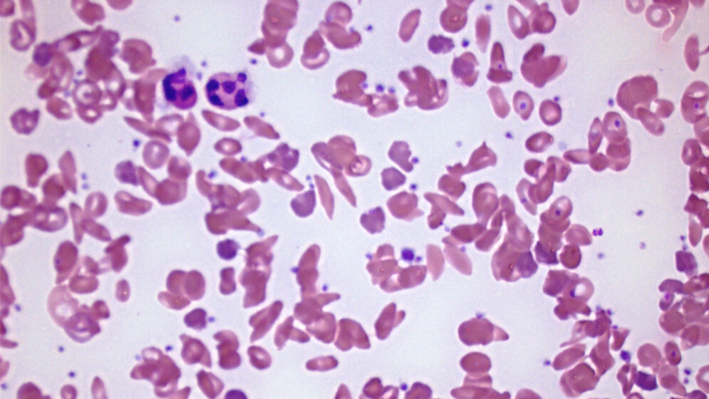 Blutausstrich bei Sichelzellenanämie