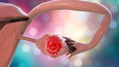 Modell von Eierstockkrebs