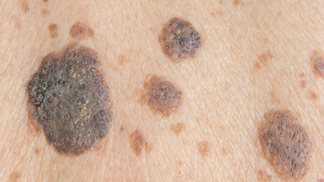 Melanom_srisakorn.jpg Melanom