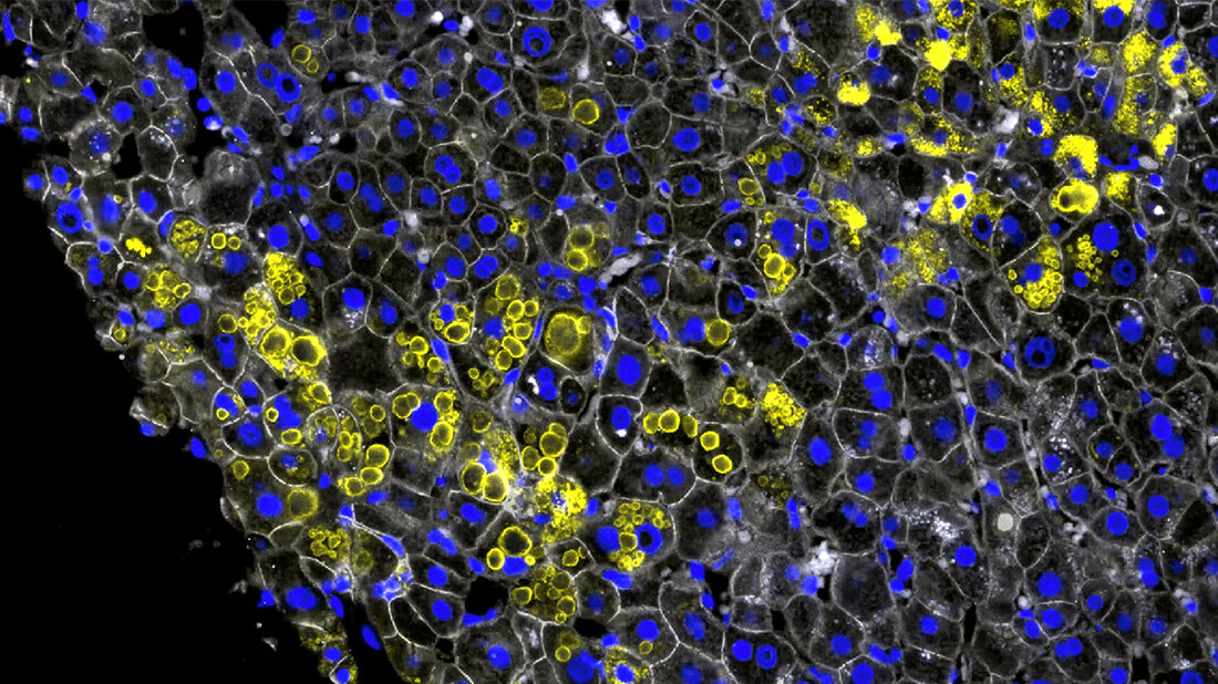 leberbiopsie_alpha-1-aggregate.jpg Leberbiopsie Alpha-1-Aggregate