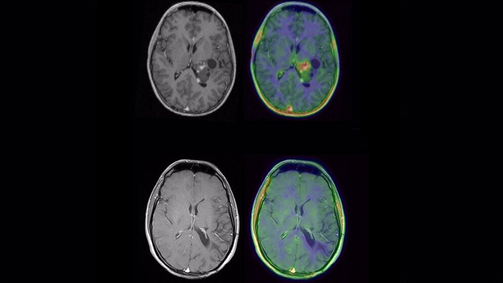 MRT eines Patienten mit Glioblastom