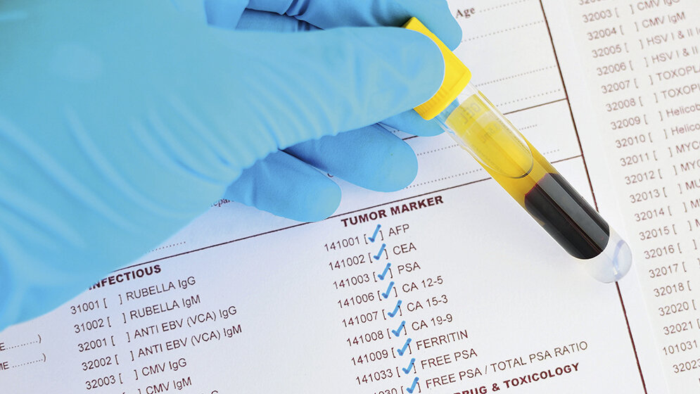 Labordiagnostik Tumormarker-Einsatz
