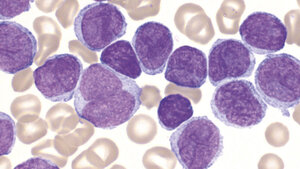 Mantelzell-Lymphome