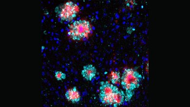 Alzheimer_Marker.jpg Protein Arl8b (türkis) zeigt eine Anhäufung um die Amyloid-b-Aggregate (rot).