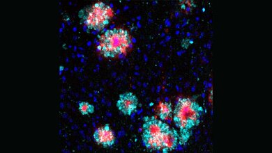  Protein Arl8b (türkis) zeigt eine Anhäufung um die Amyloid-b-Aggregate (rot). 