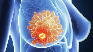 Neue Therapien bei HER2+ Brustkrebs?