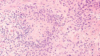 Glioblastom_Cannabidiol.jpg Glioblastom