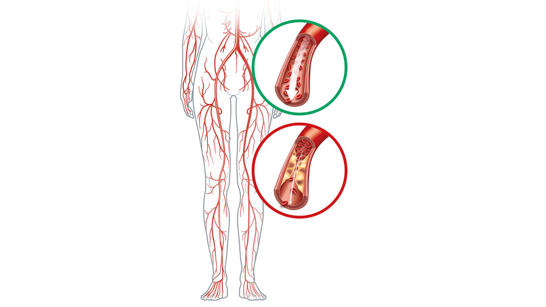 Symbolbild für PAVK.
