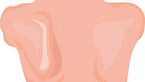 Illustration einer Scapula alata (Flügelschulterblatt) mit charakteristisch abstehendem Schulterblatt