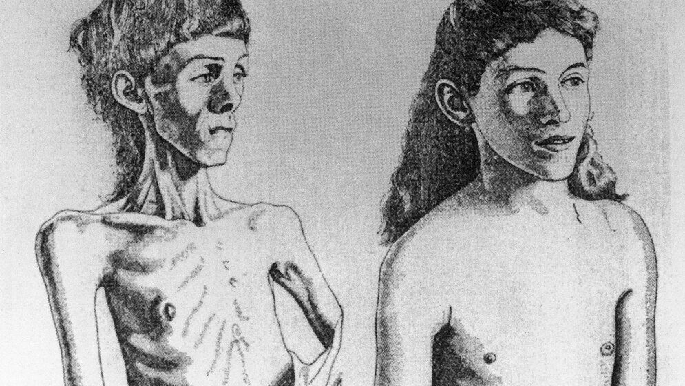 Anorexia Nervosa.