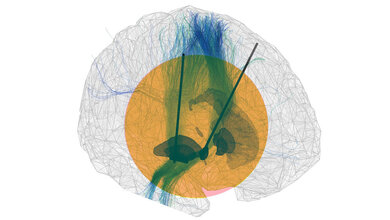 Das_menschliche_Gehirn_als_Computersimulation_Tiefe_Hirnstimulation_Neumann_Charite.jpg Das menschliche Gehirn als Computersimulation