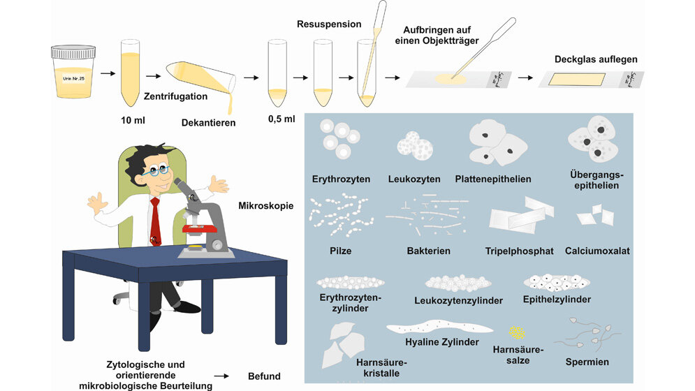 Laboratoriumsmedizin Repetitorium: Urinsedimentequiz (Teil 4)