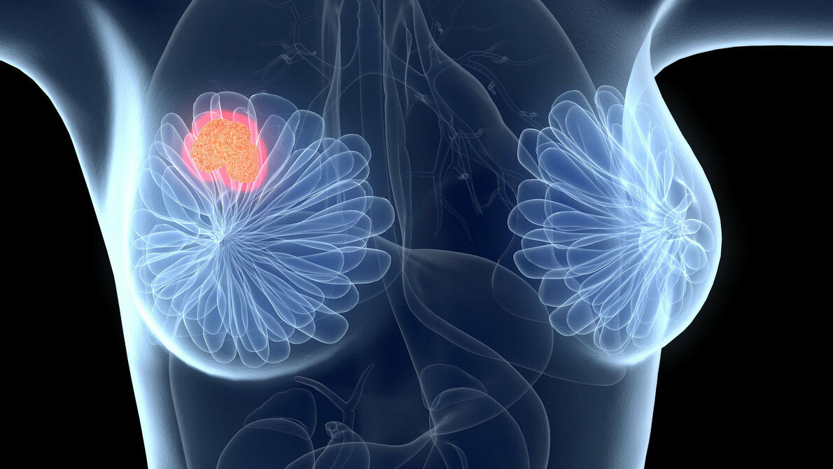 Brustkrebs_Fotolia.jpg Grenzwert