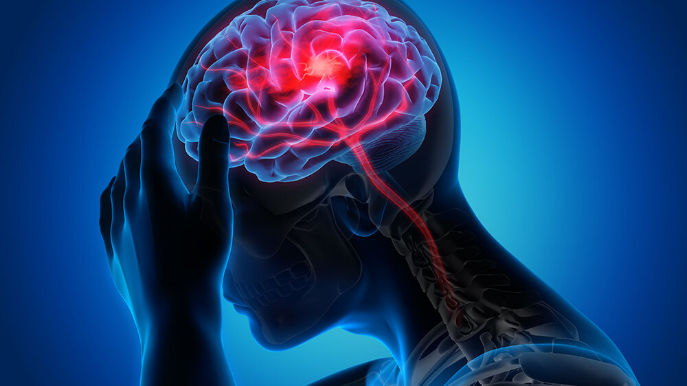 Schlaganfall.jpeg Schlaganfall Gehirn