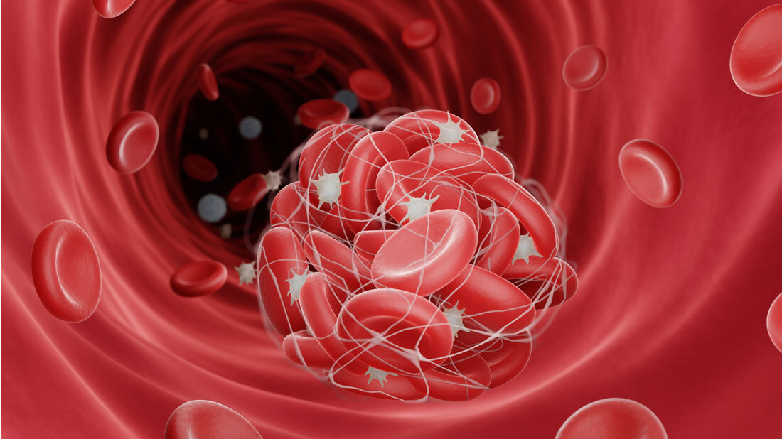 Thrombose