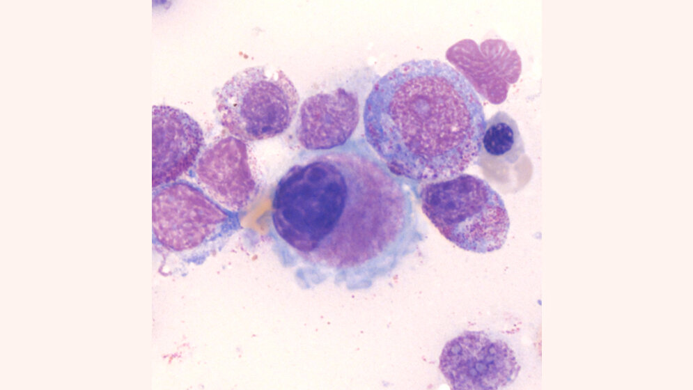 Hämatologie Dysthrombopoese