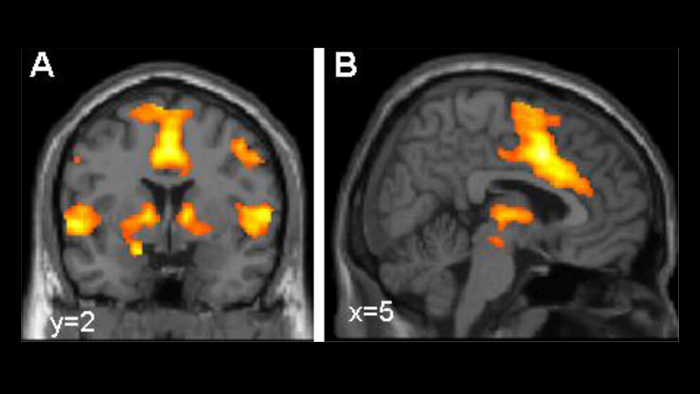 Aktivierung_des_Furchtnetzes_funktionelle_Kernspintomographie_Bild_Dr_Tina_Lonsdorf_Systemische_Neurowissenschaften_UKE_Hamburg.jpg Aktivierung des Furchtnetzes im Gehirn