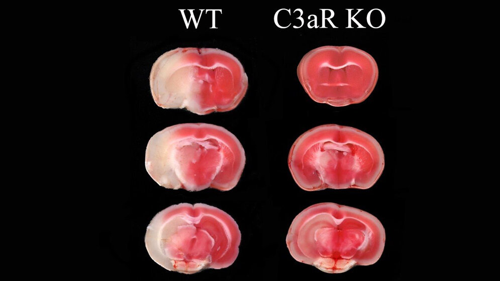 nach einem Schlaganfall ist das geschädigte Hirnareal (weiß) relativ groß