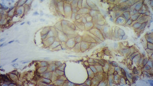 Routinediagnostik in der Pathologie, Differenzialdiagnostik bei Tumorerkrankungen