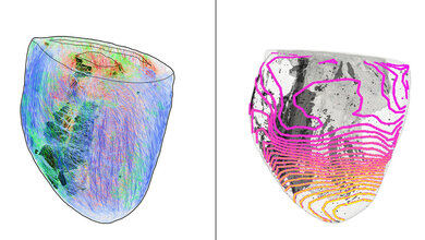 Zwei 3D-Darstellungen eines Herzens, bunt zur Darstellung der faserartigen Anordnung der Muskeln und zur Visualisierung der Erregerausbreitung, graue Bereiche zeigen Narbengewebe