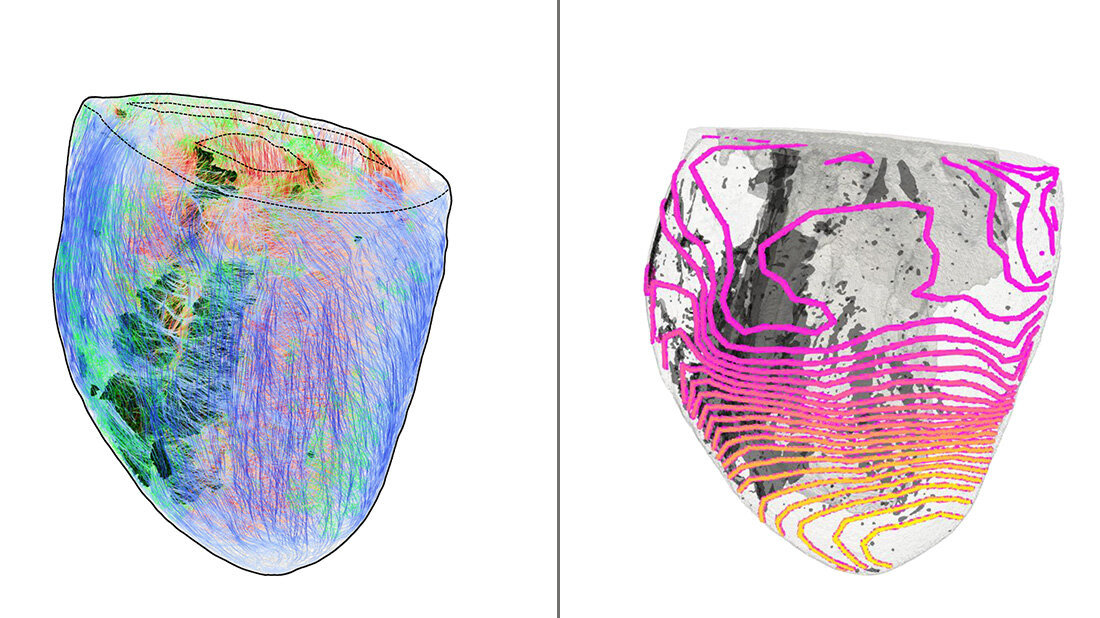 Zwei 3D-Darstellungen eines Herzens, bunt zur Darstellung der faserartigen Anordnung der Muskeln und zur Visualisierung der Erregerausbreitung, graue Bereiche zeigen Narbengewebe