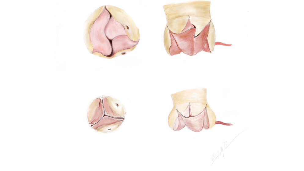 Illustration der Ozaki-Klappe