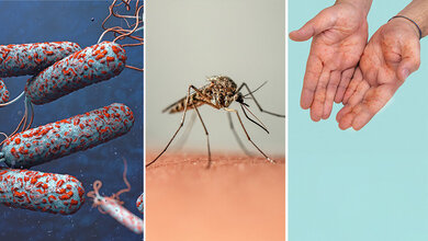 Dengue Fieber, Cholera, MPox