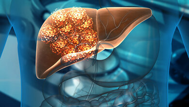 Leberkrebszellen.jpg Leberkrebszellen.jpg