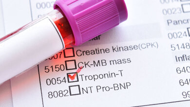 Troponin_01.jpg Laborwert Troponin