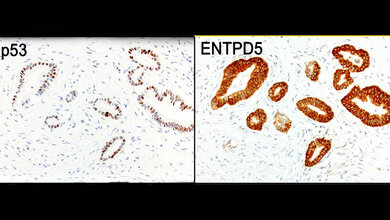Ausschnitt aus einem Bauchspeicheldrüsen-Tumor