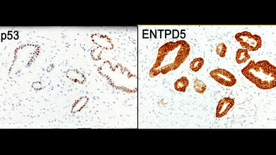 Ausschnitt aus einem Bauchspeicheldrüsen-Tumor