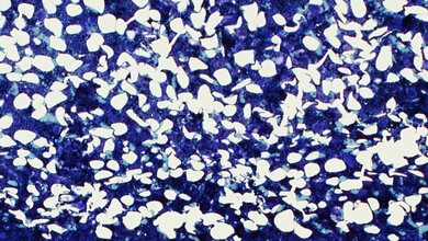 Ersatz von Knochenmark