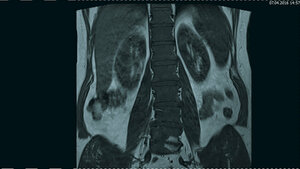 Tumoröse Veränderungen: Polyzythämia vera