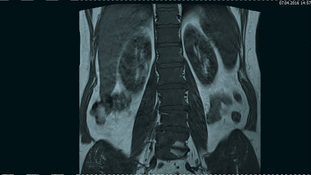 Tumoröse Veränderungen: Polyzythämia vera