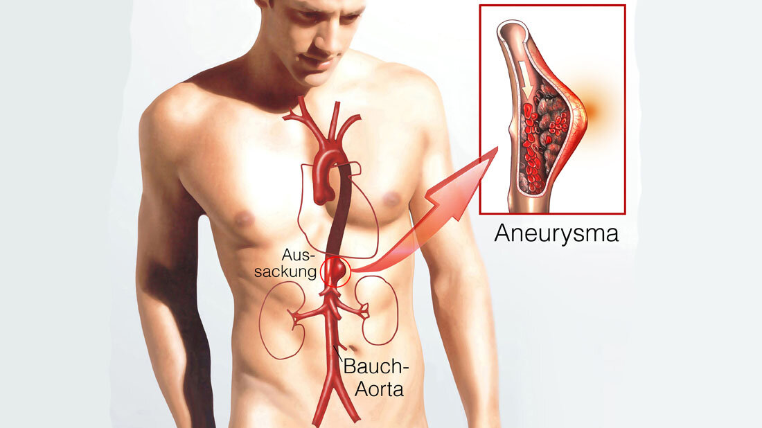 Aneurysma