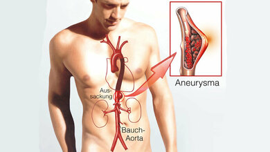 Aneurysma