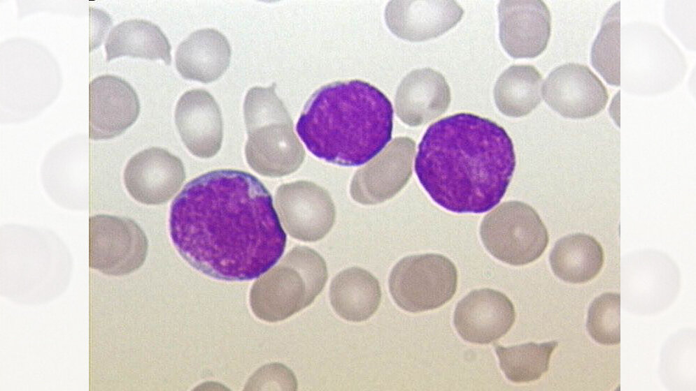 Blutausstrich eines Patienten mit ALL