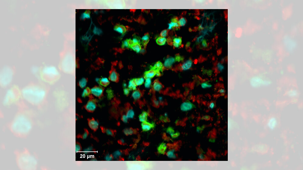 LCH-Zellen aus einer Tumorbiopsie