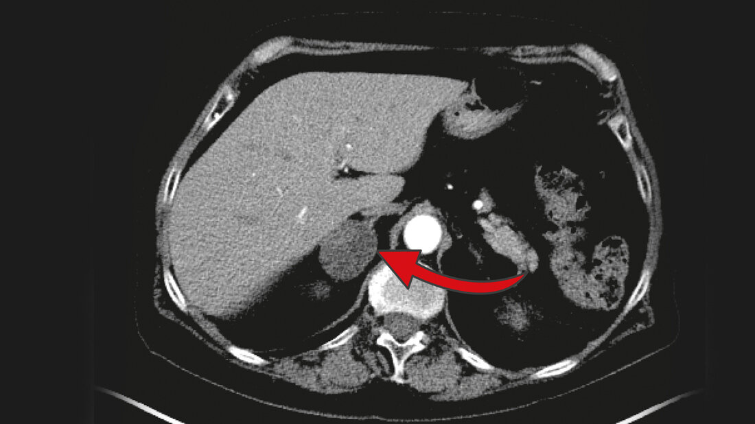 Drei Zentimeter großer Nebennierentumor 