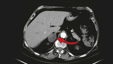 Drei Zentimeter großer Nebennierentumor 