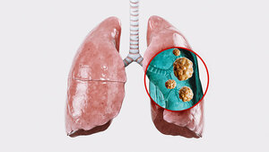 3D-Darstellung der Lunge