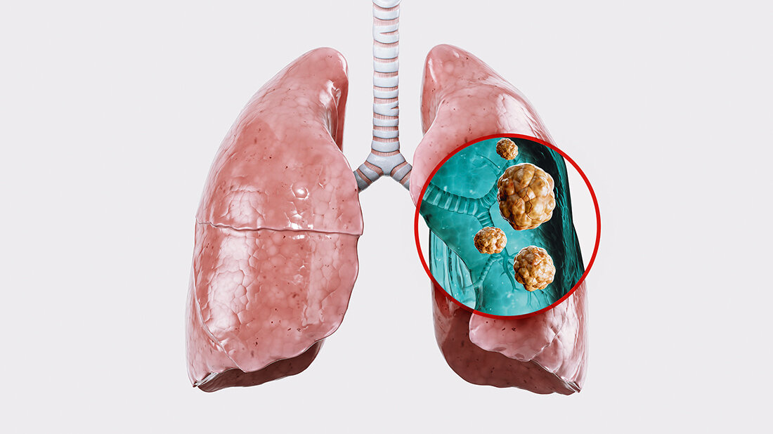 3D-Darstellung der Lunge