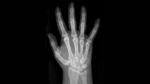 Titelbild des Fachbeitrags zur Bildgebung bei Brachydaktylie und Brachymetacarpie