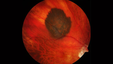 Aderhautmelanom zeichnet sich dunkel gegen das gesunde Gewebe des Augenhintergrundes ab.