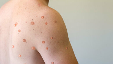 Affenpocken, ja oder nein? PoxApp hilft bei der Einordnung