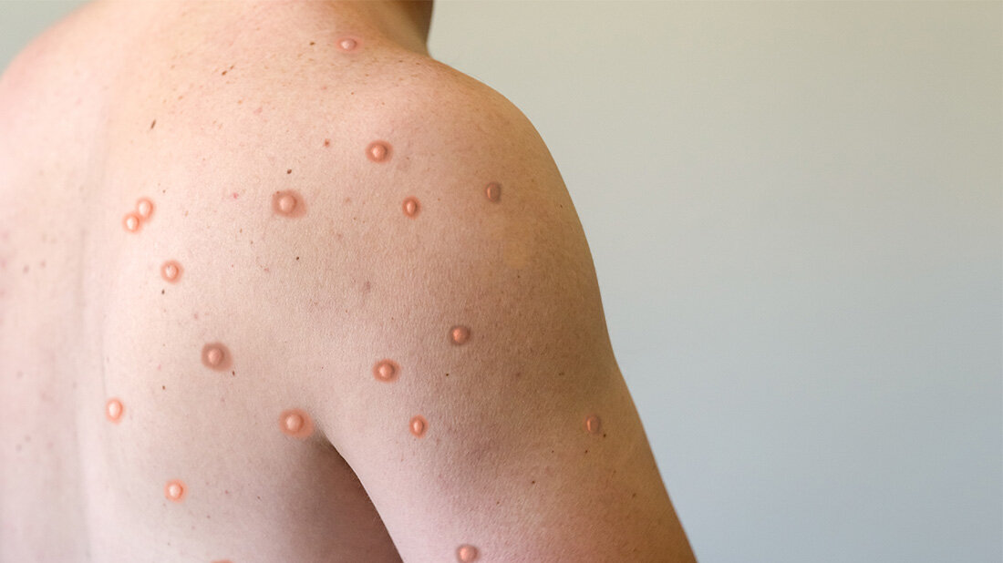 Affenpocken, ja oder nein? PoxApp hilft bei der Einordnung