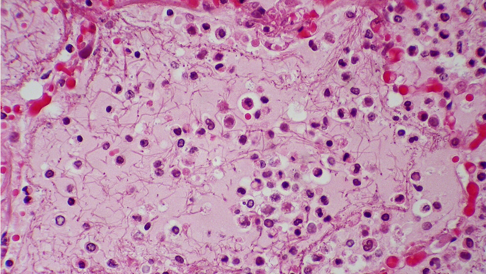 Pneumonie_Yale_Rosen.jpg Frühe Pneumonie