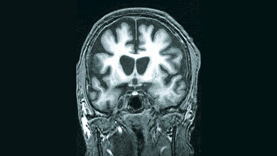 Atrophie bestimmter Hirnregionen
