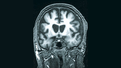 Neurologie Atrophie bestimmter Hirnregionen