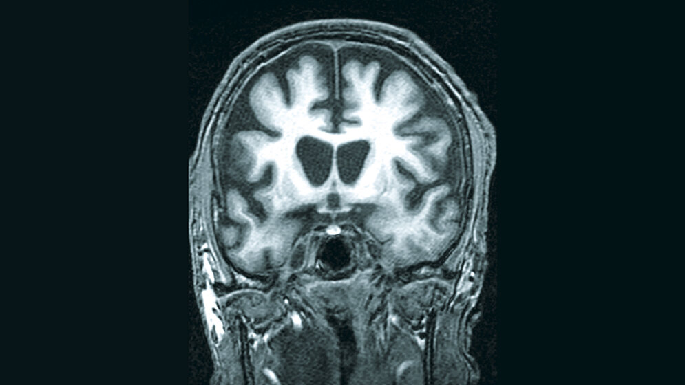 Atrophie bestimmter Hirnregionen
